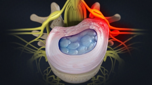 Difference Between a Bulging Disc and Herniated Disc