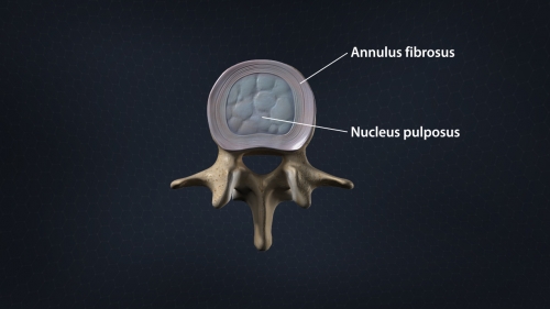 Difference Between a Bulging Disc and Herniated Disc