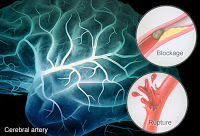 Know the Signs of Stroke – The Life You Save Could be Your Own