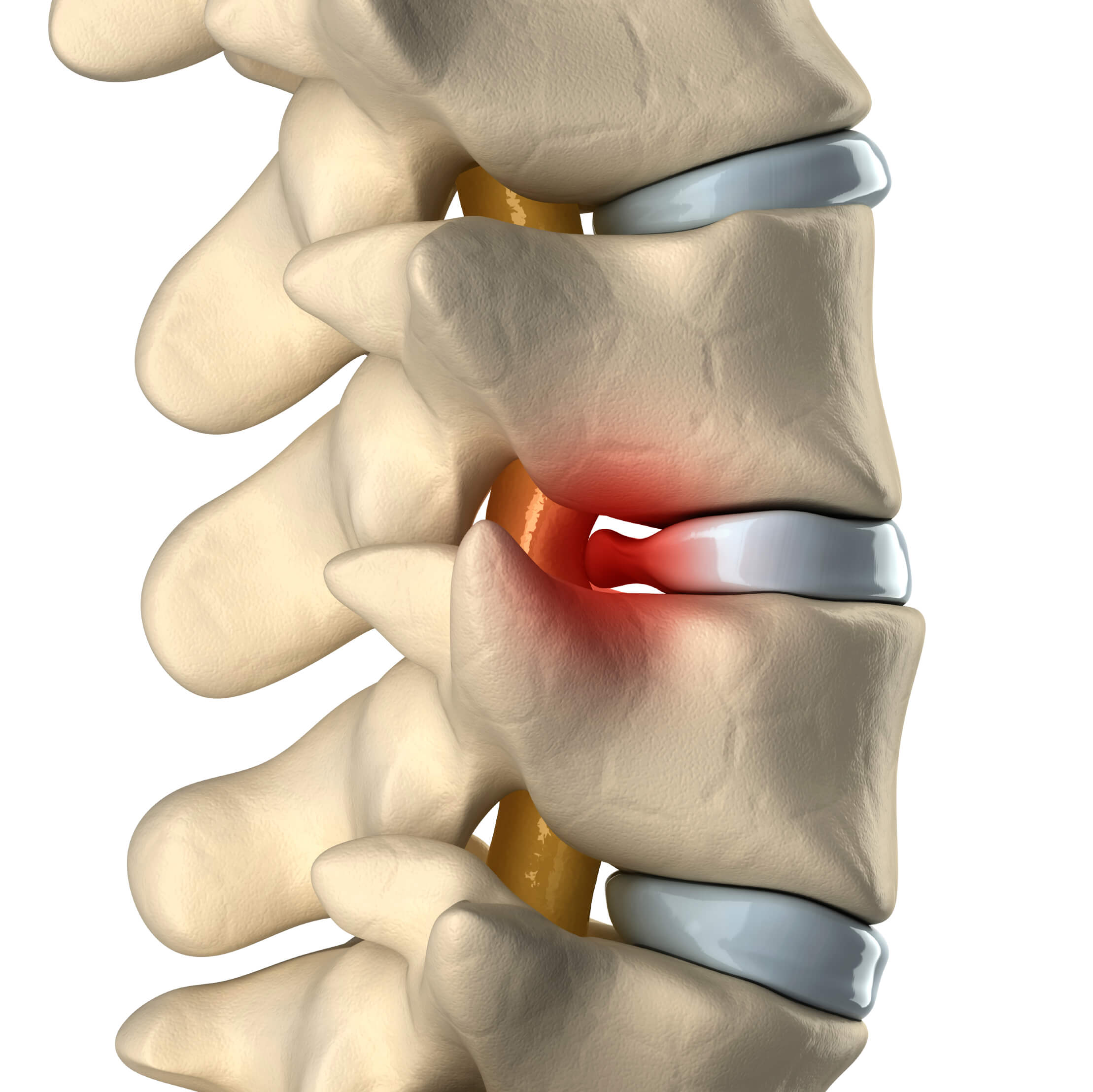 Causes & Treatments of Lumbar Herniated Discs