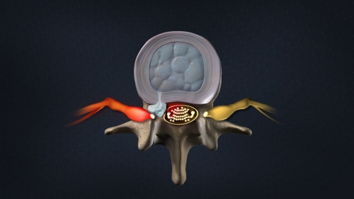 What Is the Difference between a Bulging Disc and a Herniated Disc?