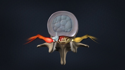 A Herniated Disc or a Bulging Disc: Is There a Difference, and How