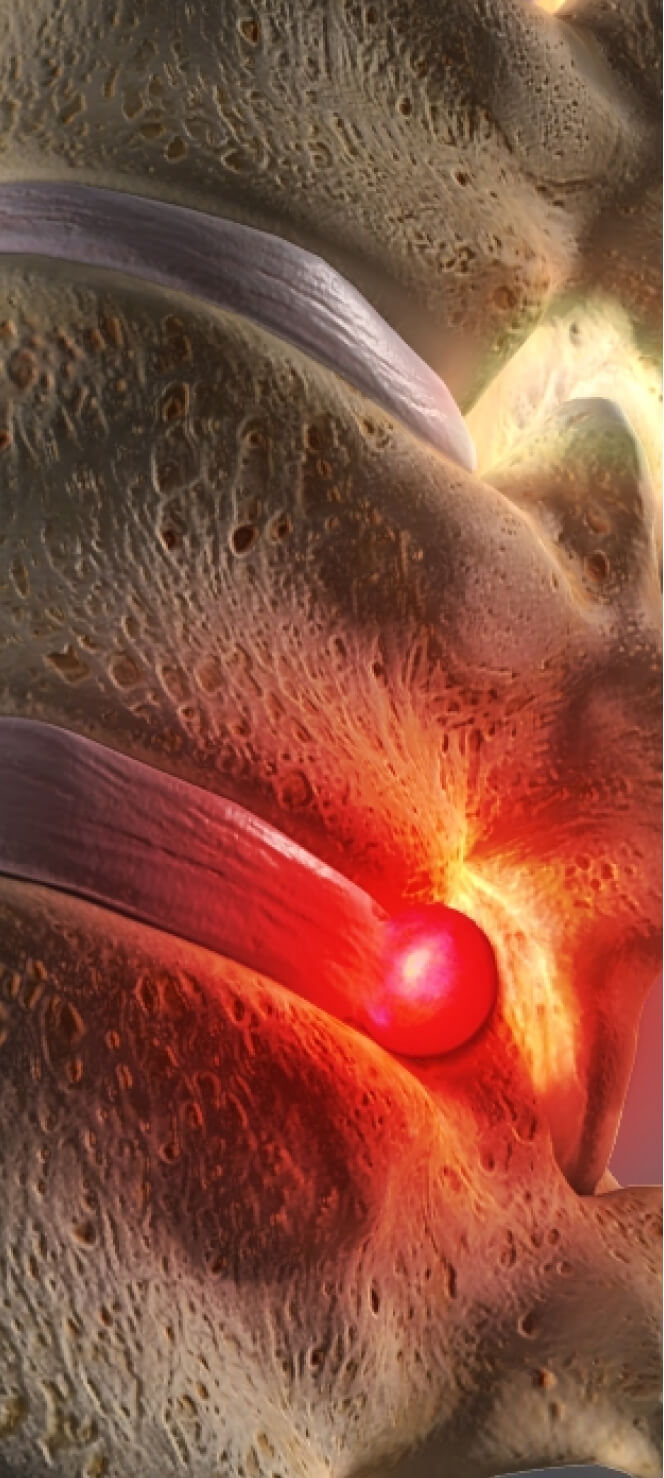 common symtoms of a herniated disc