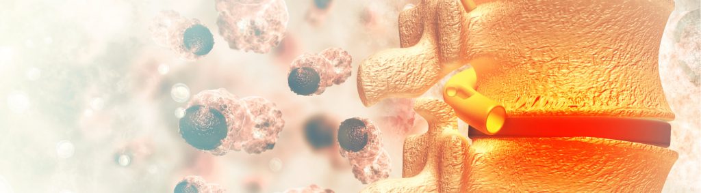 Degenerative Disc Disease | Symptom & Treatments in Houston, TX